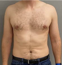 Male Breast Reduction After Photo by Keshav Magge, MD; Bethesda, MD - Case 44703