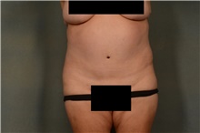 Tummy Tuck After Photo by Ellen Janetzke, MD; ,  - Case 44715