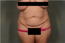 Tummy Tuck Before Photo by Ellen Janetzke, MD; ,  - Case 44715