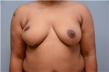 Breast Reconstruction Before Photo by Carlos Rivera-Serrano, MD; ,  - Case 44732