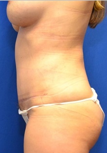 Tummy Tuck After Photo by Stanley Okoro, MD; ,  - Case 44851