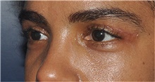 Eyelid Surgery After Photo by Jerry Weiger Chang, MD, FACS; Flushing, NY - Case 44885