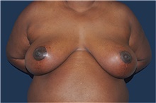 Breast Reconstruction After Photo by Jerry Weiger Chang, MD, FACS; Flushing, NY - Case 44887