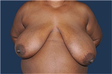 Breast Reconstruction Before Photo by Jerry Weiger Chang, MD, FACS; Flushing, NY - Case 44887