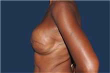 Breast Reconstruction After Photo by Jerry Weiger Chang, MD, FACS; Flushing, NY - Case 44893