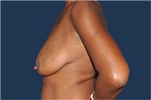 Breast Reconstruction Before Photo by Jerry Weiger Chang, MD, FACS; Flushing, NY - Case 44893