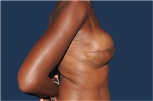 Breast Reconstruction After Photo by Jerry Weiger Chang, MD, FACS; Flushing, NY - Case 44893