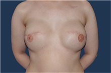 Breast Reconstruction After Photo by Jerry Weiger Chang, MD, FACS; Flushing, NY - Case 44894