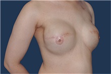 Breast Reconstruction After Photo by Jerry Weiger Chang, MD, FACS; Flushing, NY - Case 44894