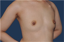 Breast Reconstruction Before Photo by Jerry Weiger Chang, MD, FACS; Flushing, NY - Case 44894