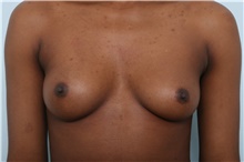 Breast Augmentation Before Photo by Paul Vitenas, Jr., MD; Houston, TX - Case 44900