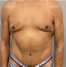 Tummy Tuck After Photo by Keshav Magge, MD; Bethesda, MD - Case 44927