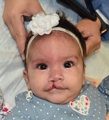 Cleft Lip and Palate Repair Before Photo by Rachel Ruotolo, MD; Garden City, NY - Case 44968