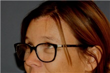 Brow Lift After Photo by Steve Laverson, MD, FACS; Rancho Santa Fe, CA - Case 44984