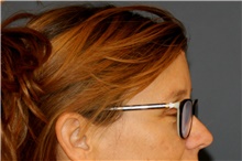 Brow Lift After Photo by Steve Laverson, MD, FACS; Rancho Santa Fe, CA - Case 44984