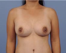 Mommy Makeover After Photo by Katerina Gallus, MD, FACS; San Diego, CA - Case 45292