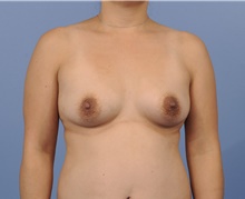 Mommy Makeover Before Photo by Katerina Gallus, MD, FACS; San Diego, CA - Case 45292