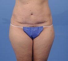 Tummy Tuck After Photo by Katerina Gallus, MD, FACS; San Diego, CA - Case 45321