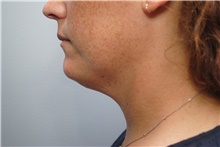 Liposuction Before Photo by Ellen Mahony, MD; Westport, CT - Case 45417