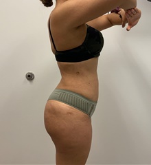 Buttock Lift with Augmentation After Photo by Johnny Franco, MD; ,  - Case 45442