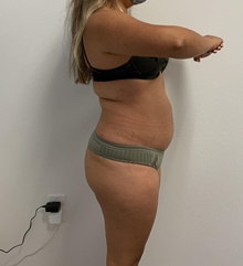Buttock Lift with Augmentation Before Photo by Johnny Franco, MD; ,  - Case 45442