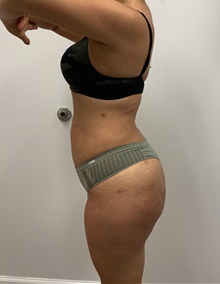 Buttock Lift with Augmentation After Photo by Johnny Franco, MD; ,  - Case 45442