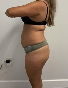 Buttock Lift with Augmentation Before Photo by Johnny Franco, MD; ,  - Case 45442