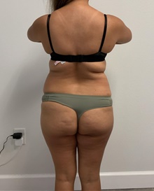 Buttock Lift with Augmentation Before Photo by Johnny Franco, MD; ,  - Case 45442