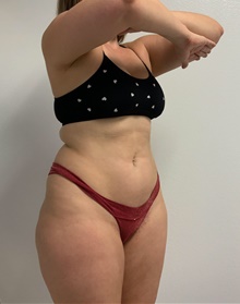 Buttock Lift with Augmentation Before Photo by Johnny Franco, MD; ,  - Case 45462