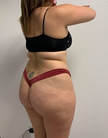 Buttock Lift with Augmentation Before Photo by Johnny Franco, MD; ,  - Case 45462