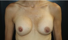 Breast Implant Removal Before Photo by Katerina Gallus, MD, FACS; San Diego, CA - Case 45491