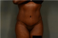 Tummy Tuck After Photo by Ellen Janetzke, MD; ,  - Case 45633