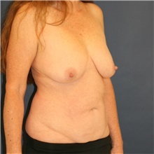 Mommy Makeover Before Photo by Steve Laverson, MD, FACS; Rancho Santa Fe, CA - Case 45680