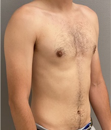 Male Breast Reduction After Photo by Keshav Magge, MD; Bethesda, MD - Case 45988