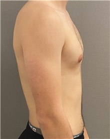 Male Breast Reduction Before Photo by Keshav Magge, MD; Bethesda, MD - Case 45988