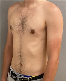 Male Breast Reduction After Photo by Keshav Magge, MD; Bethesda, MD - Case 45988