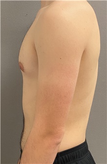 Male Breast Reduction Before Photo by Keshav Magge, MD; Bethesda, MD - Case 45988