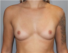 Breast Augmentation Before Photo by Ellen Mahony, MD; Westport, CT - Case 46040