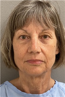 Brow Lift Before Photo by Keshav Magge, MD; Bethesda, MD - Case 46155