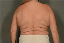 Body Lift Before Photo by Ellen Janetzke, MD; ,  - Case 46271