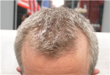 Hair Transplant Before Photo by Ellen Mahony, MD; Westport, CT - Case 46283