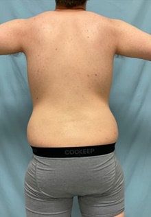 Liposuction Before Photo by Julia Spears, MD, FACS; ,  - Case 46548