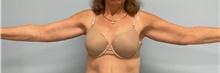 Arm Lift After Photo by Julia Spears, MD, FACS; ,  - Case 46632