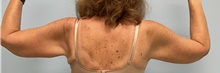Arm Lift After Photo by Julia Spears, MD, FACS; ,  - Case 46632
