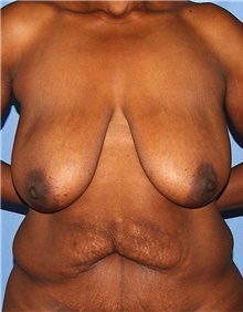 Breast Lift Before Photo by Siamak Agha, MD PhD FACS; ,  - Case 46688