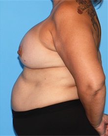 Breast Lift After Photo by Siamak Agha, MD PhD FACS; ,  - Case 46708
