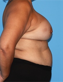 Breast Lift After Photo by Siamak Agha, MD PhD FACS; ,  - Case 46708