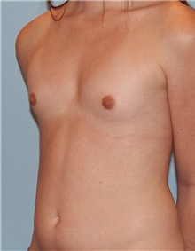 Breast Augmentation Before Photo by Siamak Agha, MD PhD FACS; ,  - Case 46734