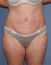 Tummy Tuck After Photo by Siamak Agha, MD PhD FACS; ,  - Case 46765