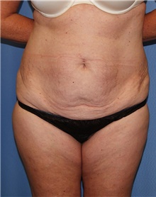 Tummy Tuck Before Photo by Siamak Agha, MD PhD FACS; ,  - Case 46765